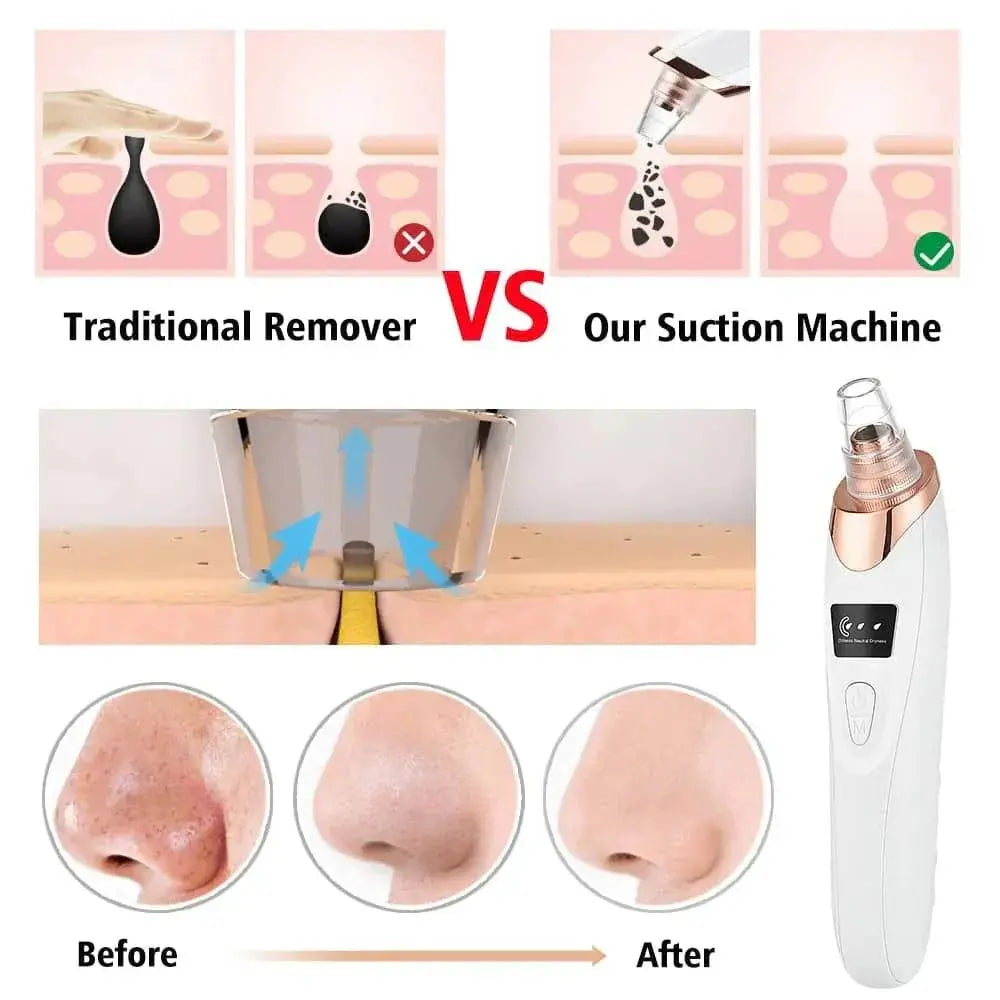 Digital Blackhead Remover Vacuum – Electric Pore Cleaner & Acne Remover Facial Tool AetherNest